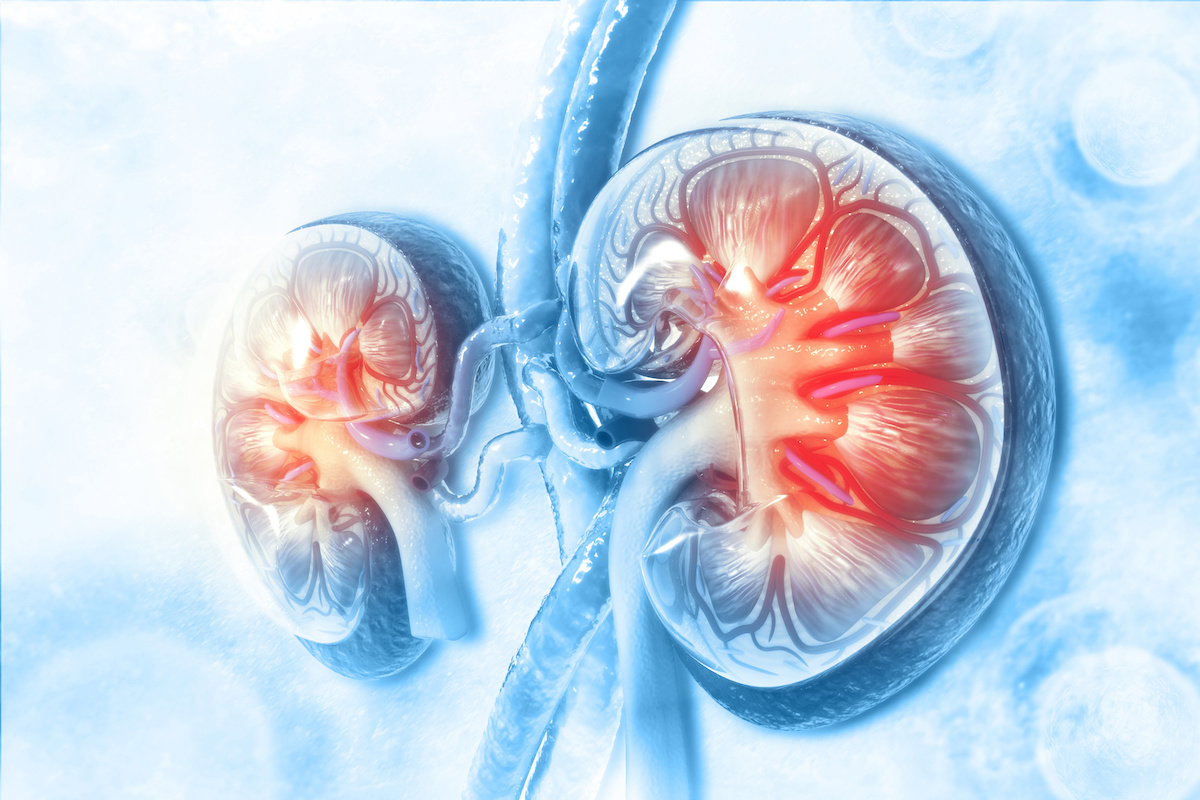 Kidney Cancer: Causes, Symptoms, & Treatment