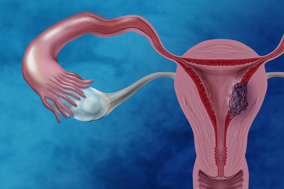 Endometrial cancer
