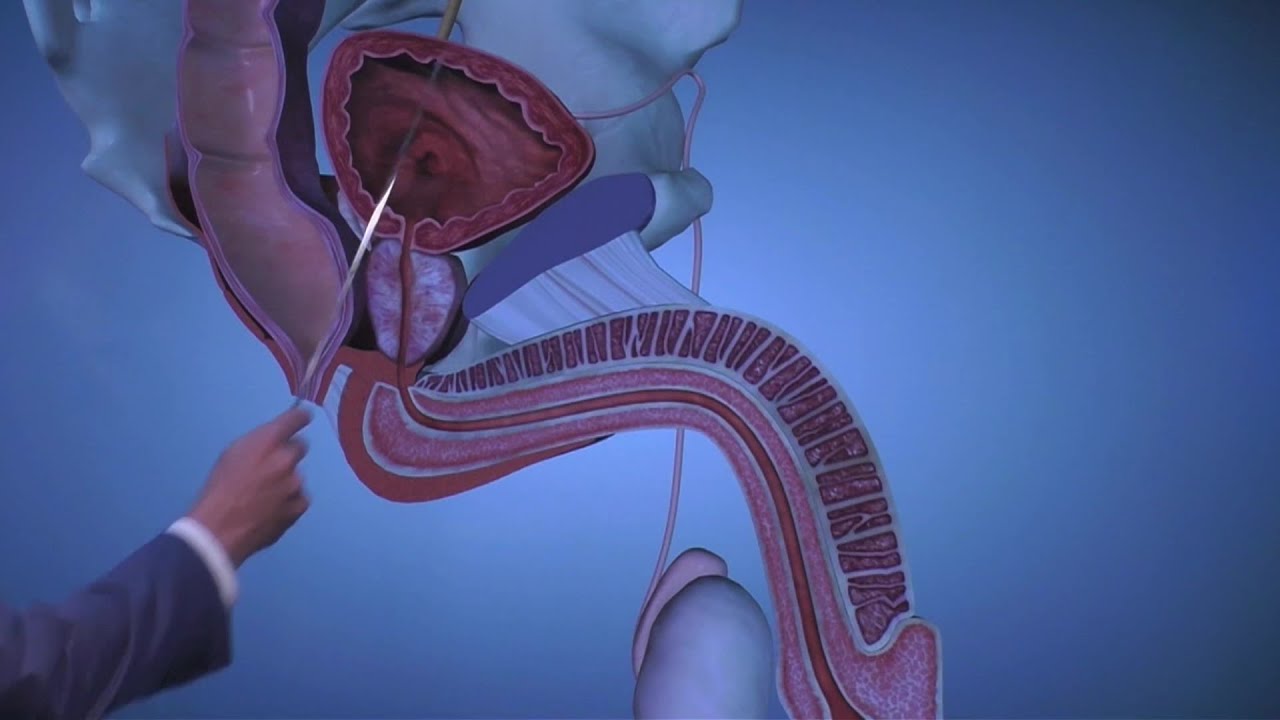 Prostate cancer 