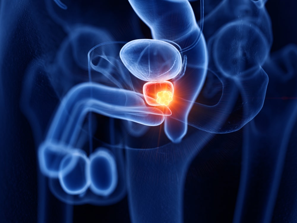 Myths about prostate cancer